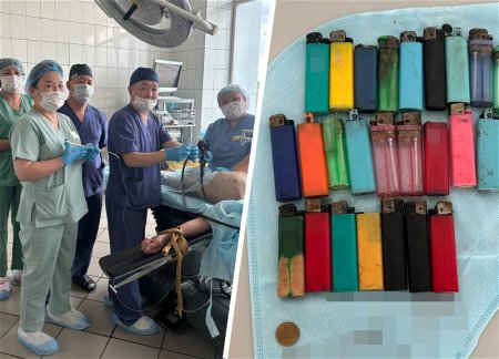 Мужчина проглотил 27 зажигалок